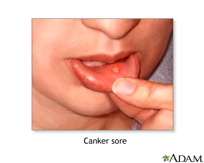 Canker sore