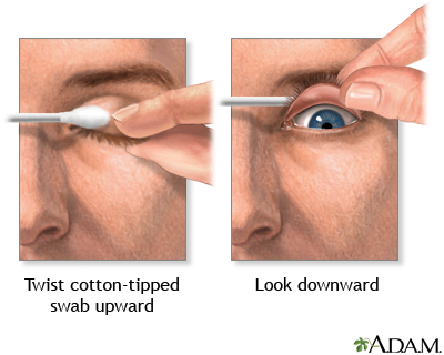 Eyelid eversion