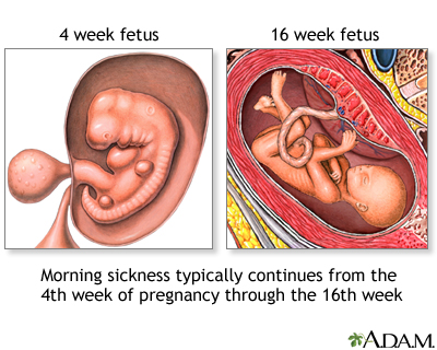 Morning sickness