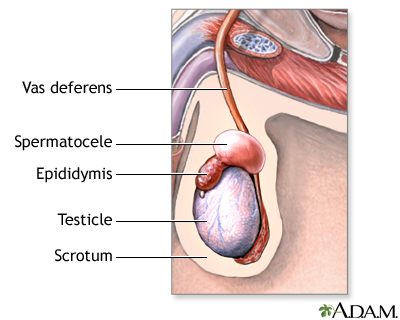 Spermatocele