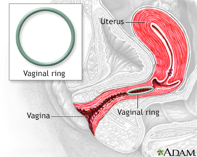 Vaginal ring