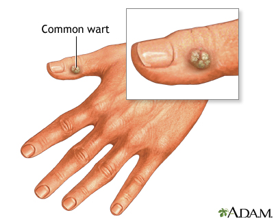 Wart