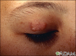 Granuloma annulare on the eyelid