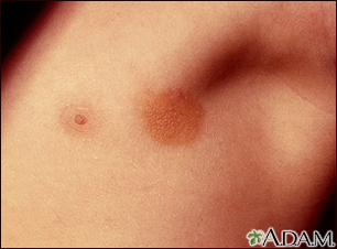 Urticaria pigmentosa in the armpit