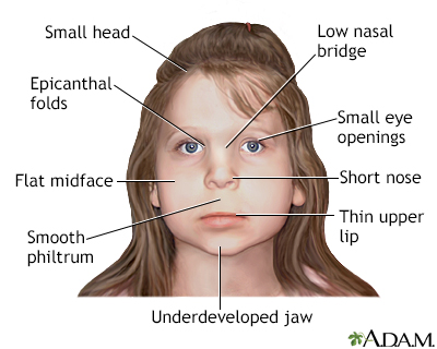 Fetal alcohol syndrome