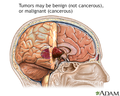 Brain tumor