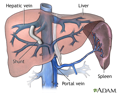 Transjugular intrahepatic portosystemic shunt