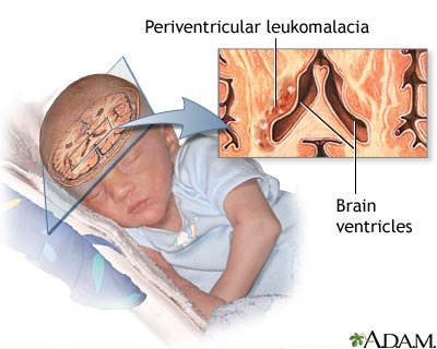 Periventricular leukomalacia