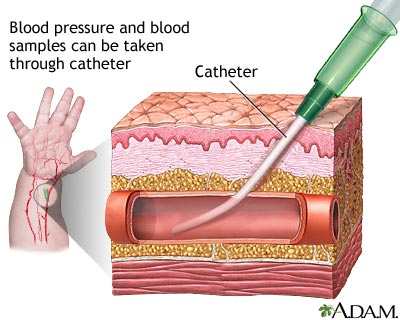 Peripheral arterial line