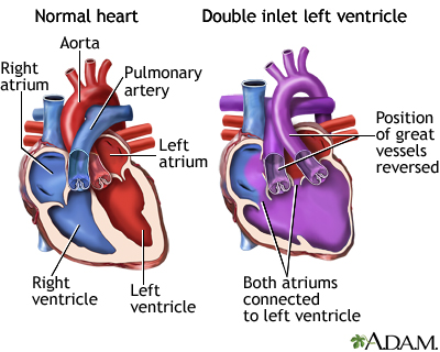 Double inlet left ventricle