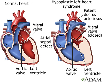 Hypoplastic left heart syndrome