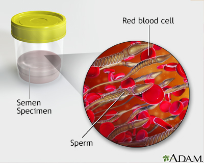 Blood in semen