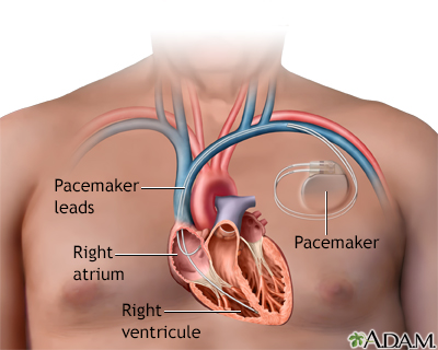 Pacemaker