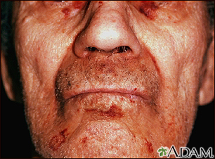 Amyloidosis of the face