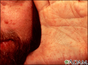 Basal cell nevus syndrome - face and hand