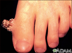 Wart (verruca) with a cutaneous horn on the toe