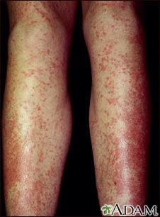 Drug rash - Tegretol