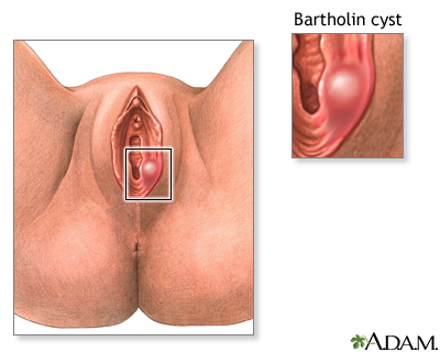 Bartholin cyst or abscess