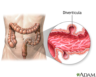 Diverticula