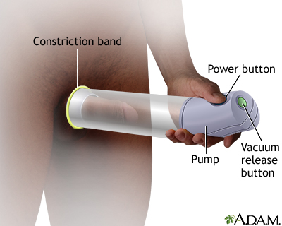 Vacuum erectile devices