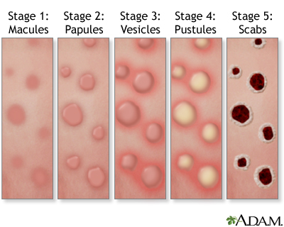 Mpox rash