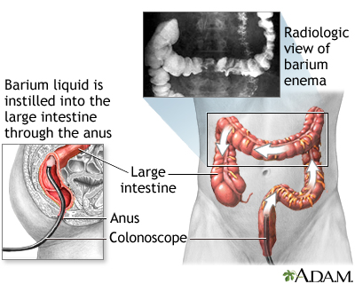 Barium enema