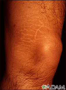 Striae on the leg