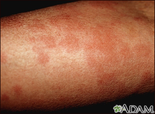 Hives (urticaria) on the arm