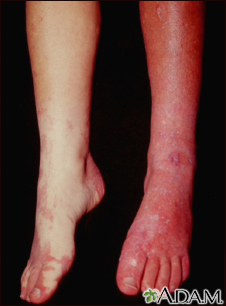 Sturge-Weber syndrome - legs