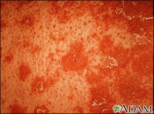 Pityriasis rubra pilaris - close-up