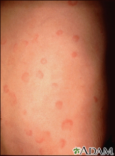 Hives (urticaria) on the back