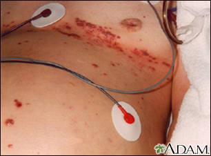 Herpes zoster (shingles) disseminated