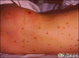 Meningococcal lesions on the back