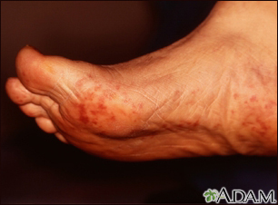 Cholesterol emboli Livedo Reticularis - feet