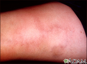 Superficial thrombophlebitis