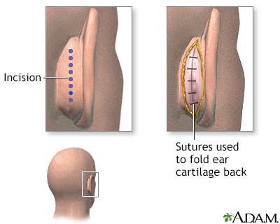 Procedure