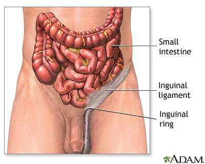 Inguinal hernia repair - series