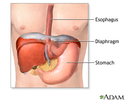 Hiatal hernia repair - series