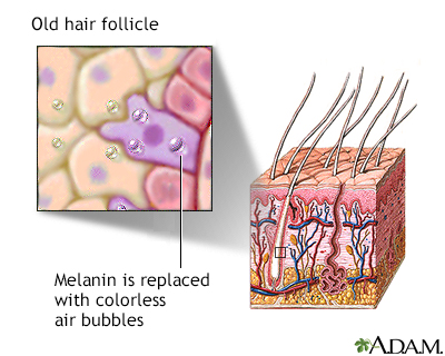 Aged hair follicle