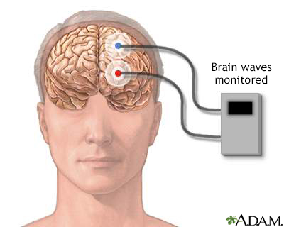 Brain wave monitor