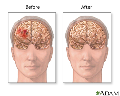 Before and after hematoma repair