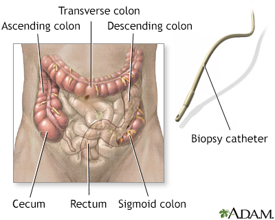 Colonoscopy