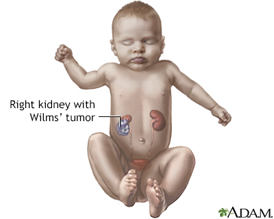 Wilms tumor