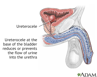 Ureterocele