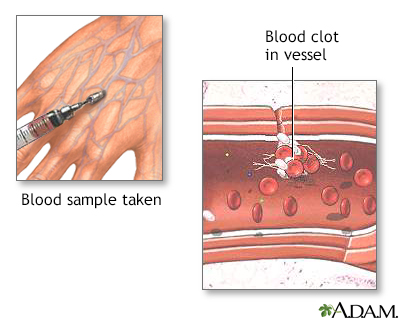 Blood clots