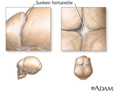 Sunken fontanelles (superior view)