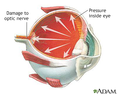 Glaucoma