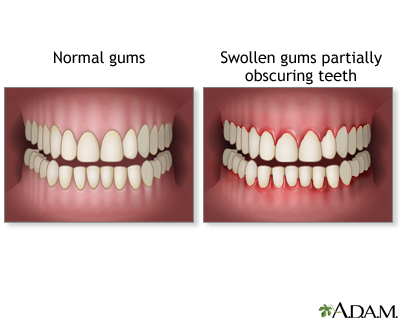 Swollen gums