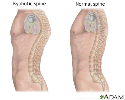 Kyphosis