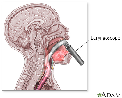 Laryngoscope